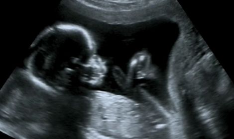 U.S. House votes to ban late-term abortions on babies who feel pain