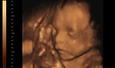 Angie was laughing before her ninth abortion. Then she saw the aborted baby